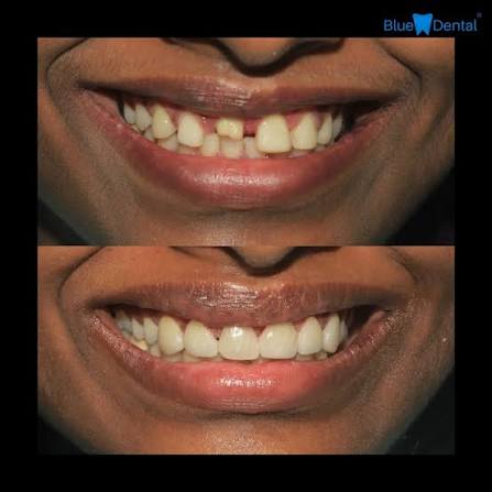 Root canal treatment before and after result